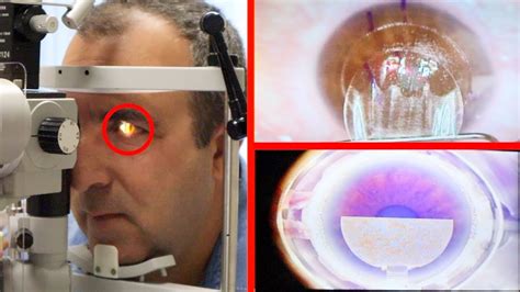 laser eye surgery cost indiana